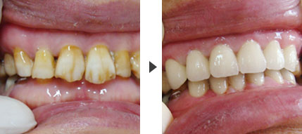 3种方法有效改善四环素牙