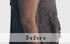 疤痕切除、局部皮瓣转移、激光疤痕
修复